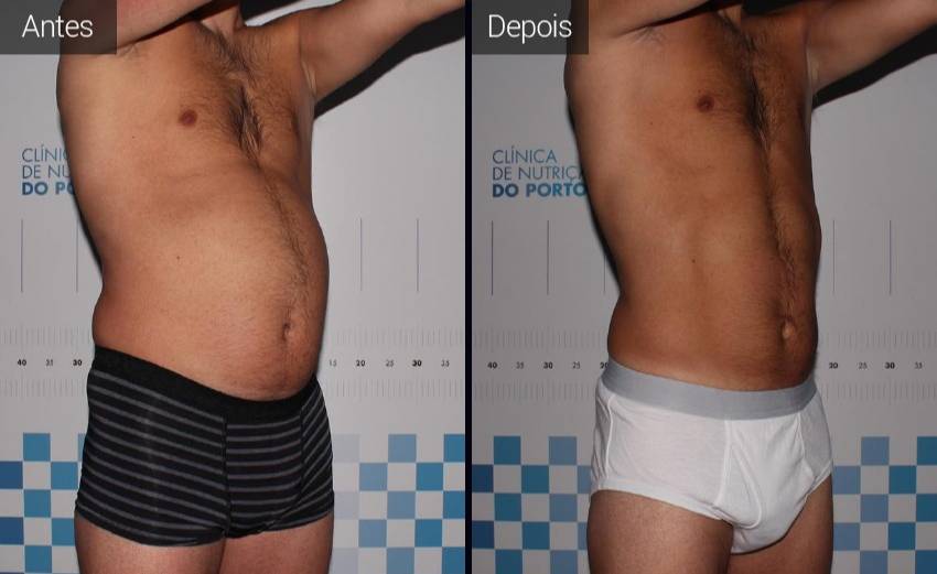 Coolsculpting - Resultados Antes e Depois - Homem - Abdómen - Vista Lateral